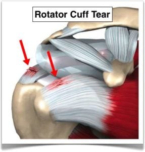 Is surgery necessary for rotator cuff tears?