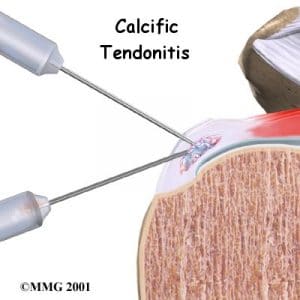 Injection for calcific tendonitis of the shoulder