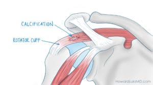 What is calcific tendonitis