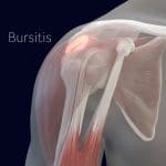 Shoulder bursitis can cause snapping