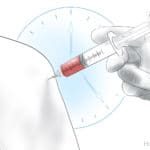 PRP injection recovery and indications