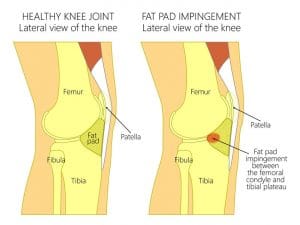 fat pad impingement and anterior knee pain
