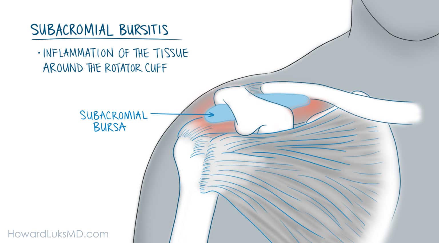 Subdeltoid Bursitis Shoulder