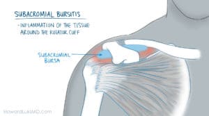 Subacromial bursitis as a cause of night pain