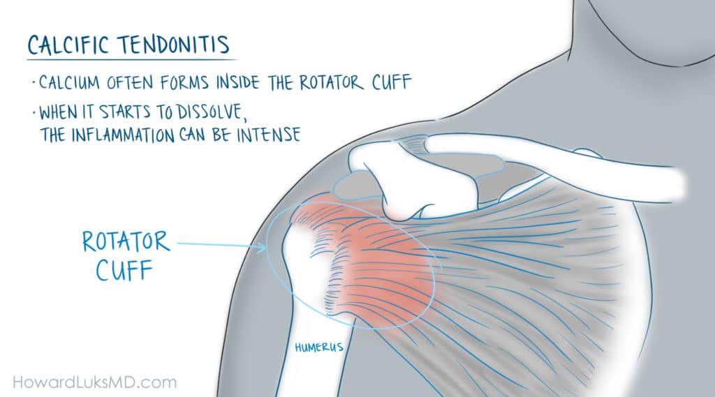 calcific tendonitis and shoulder pain at night