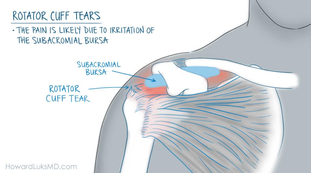 Rotator cuff tear and bursitis as a cause of shoulder pain at night