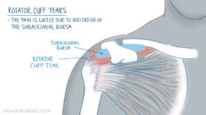 Rotator cuff tear and bursitis as a cause of shoulder pain at night