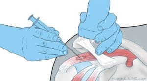 ultrasound injections to treat calcific tendonitis