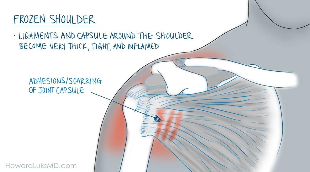 Frozen shoulder causes shoulder pain when moving the arm