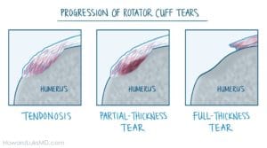 partial rotator cuff tears cause difficulty moving arm