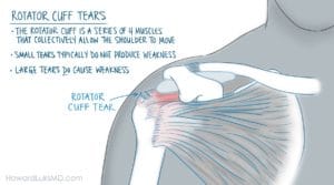 Rotator cuff tears cause pain lifting the arm