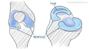 bucekt handle meniscus tear displaced