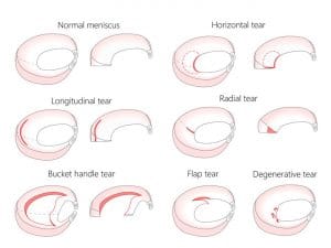 different types of meniscus tears