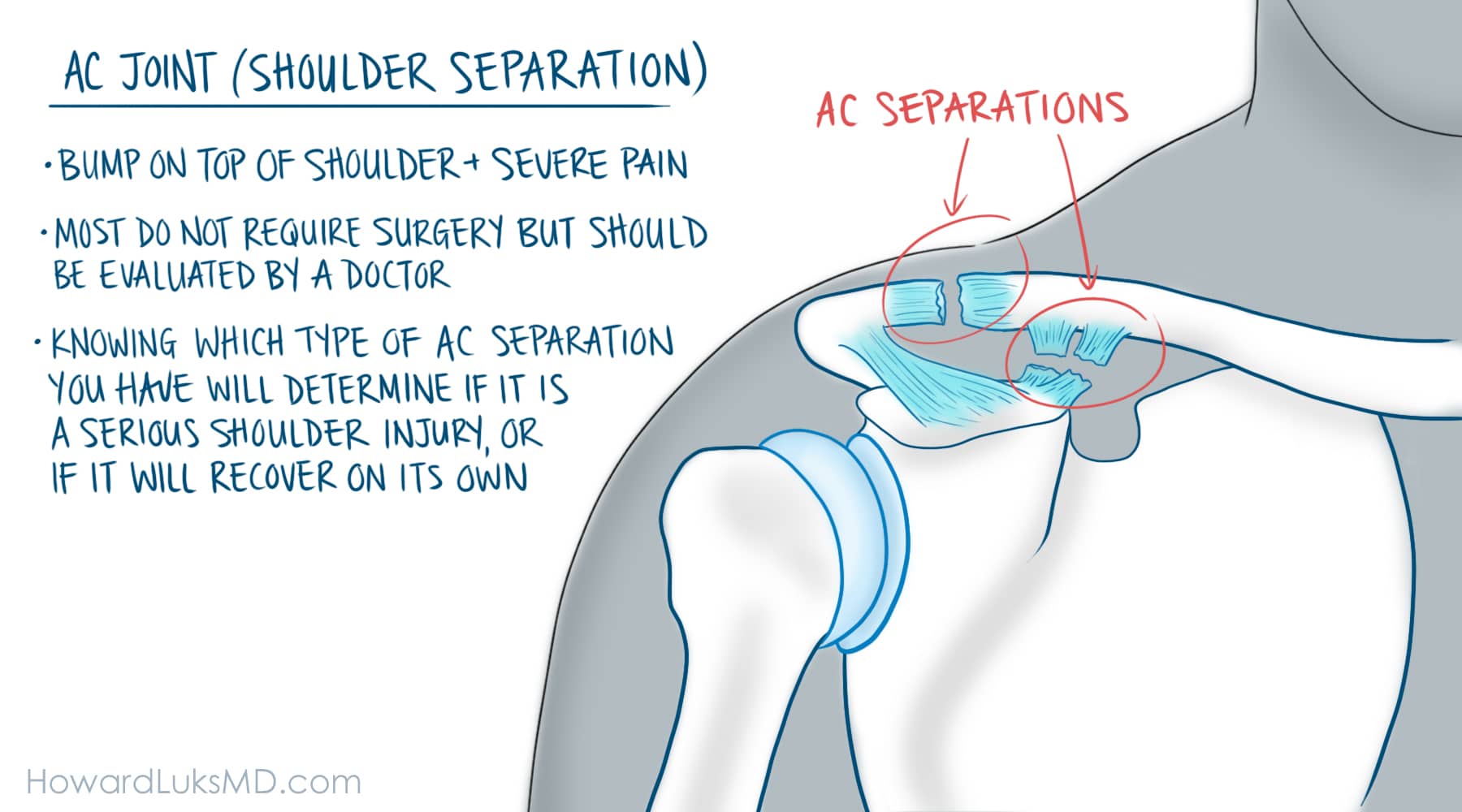AC separations severe shoulder injury howard luks md