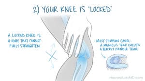 Locked knee sign of a serious knee injury