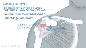 rotator cuff tear after shoulder injury