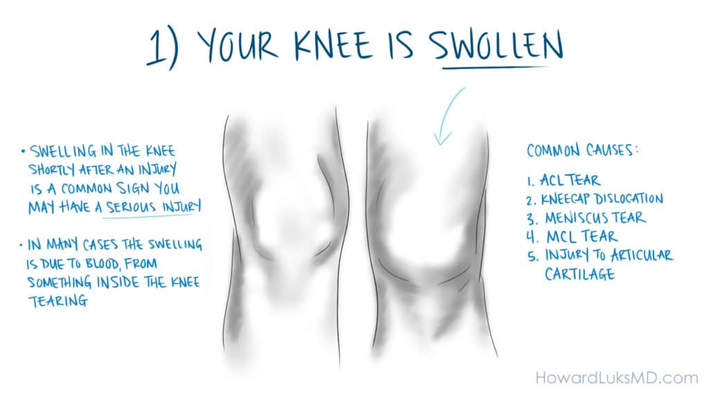 Swollen knee sign of serious knee injury