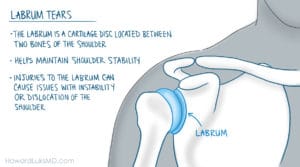 labral tears after shoulder injury or dislocation