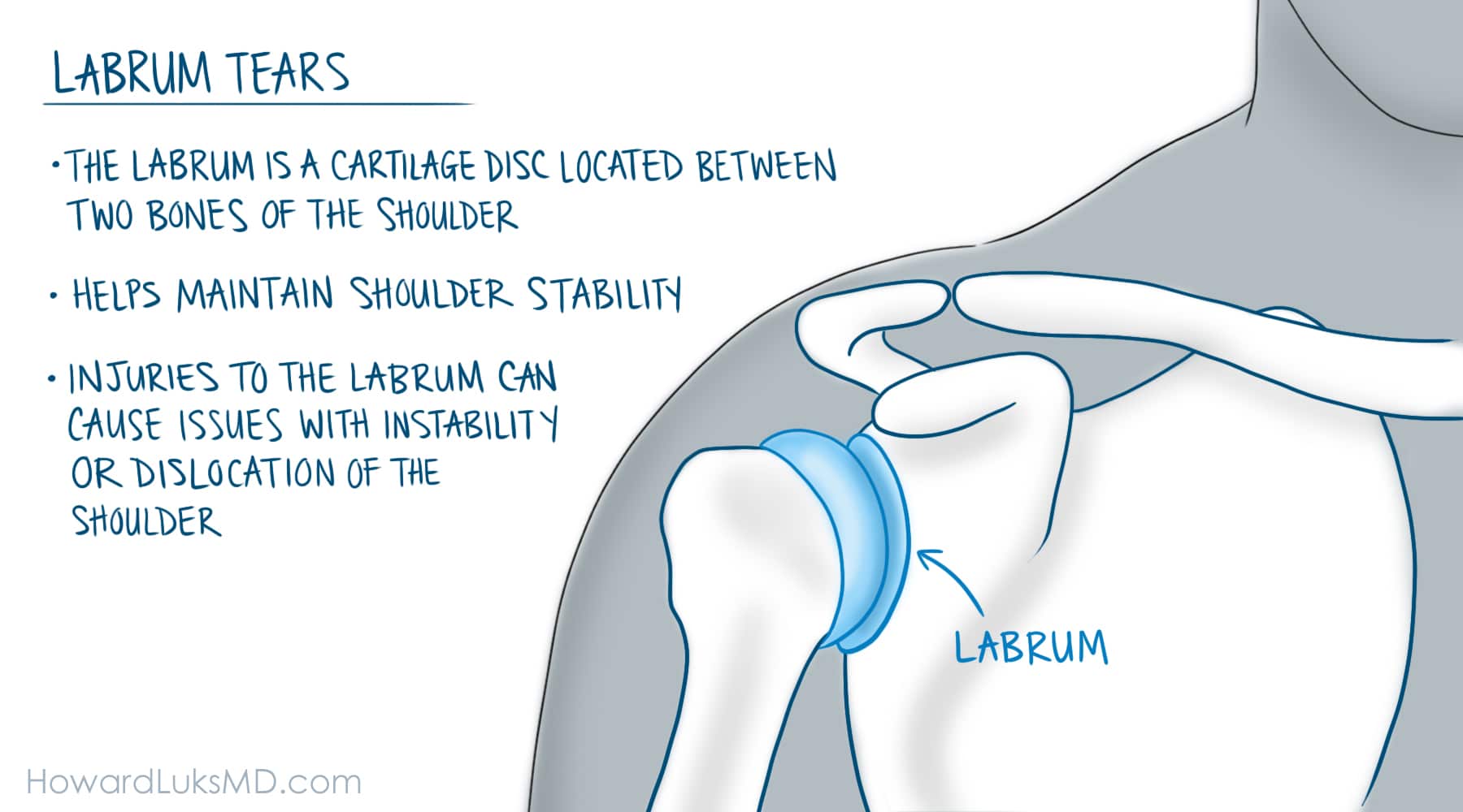 labral tears after shoulder injury or dislocation