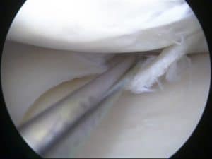 meniscus tear can cause pain behind the knee
