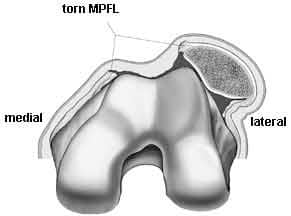 dislocated kneecap Torn MPFL
