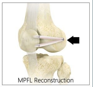 kneecap dislocation surgery MPFL