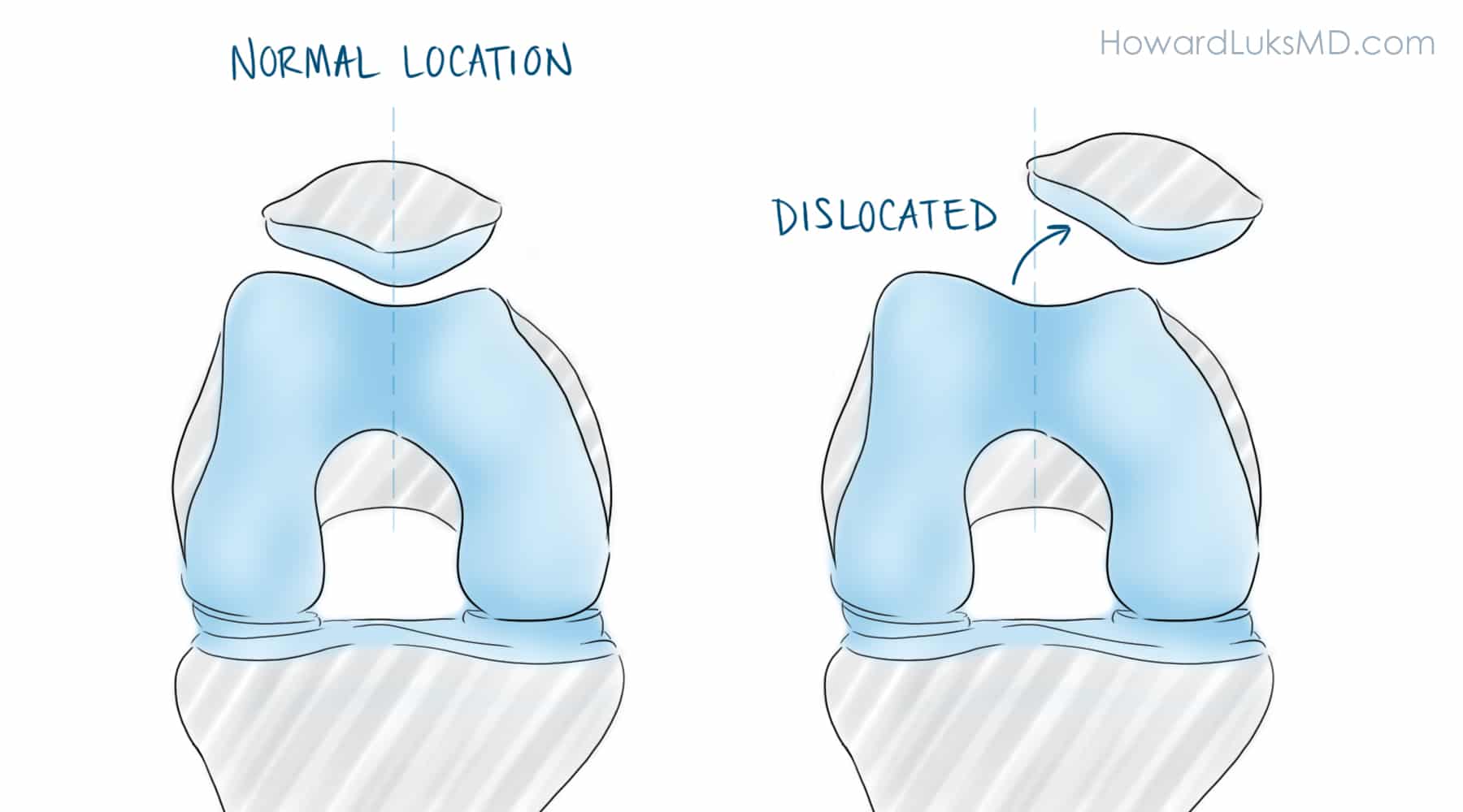 Patella kneecap dislocation