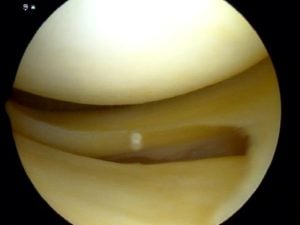 Normal Meniscus 