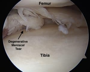 degenerative meniscus tear