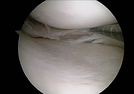 complex posterior horn meniscus tear