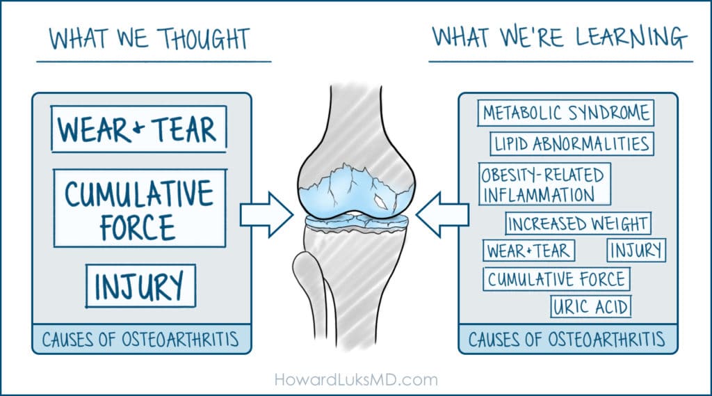 Causes of knee osteoarthritis