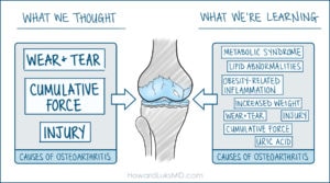 Causes of knee osteoarthritis