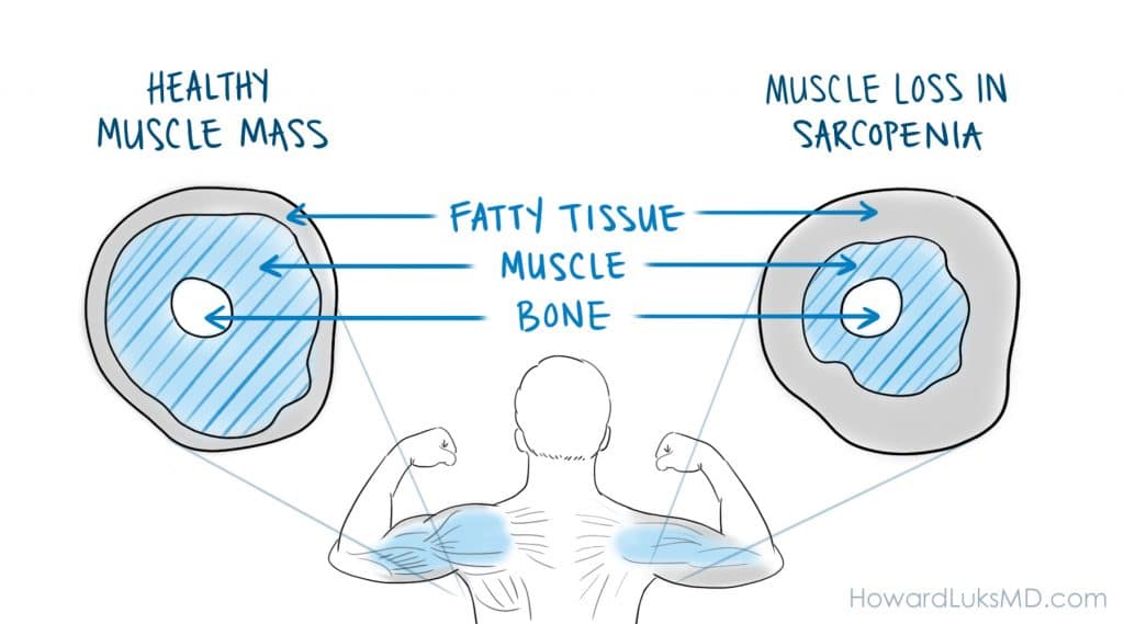 Sarcopenia age related muscle loss