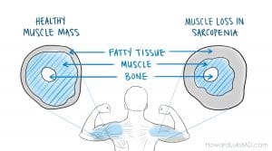 Sarcopenia age related muscle loss