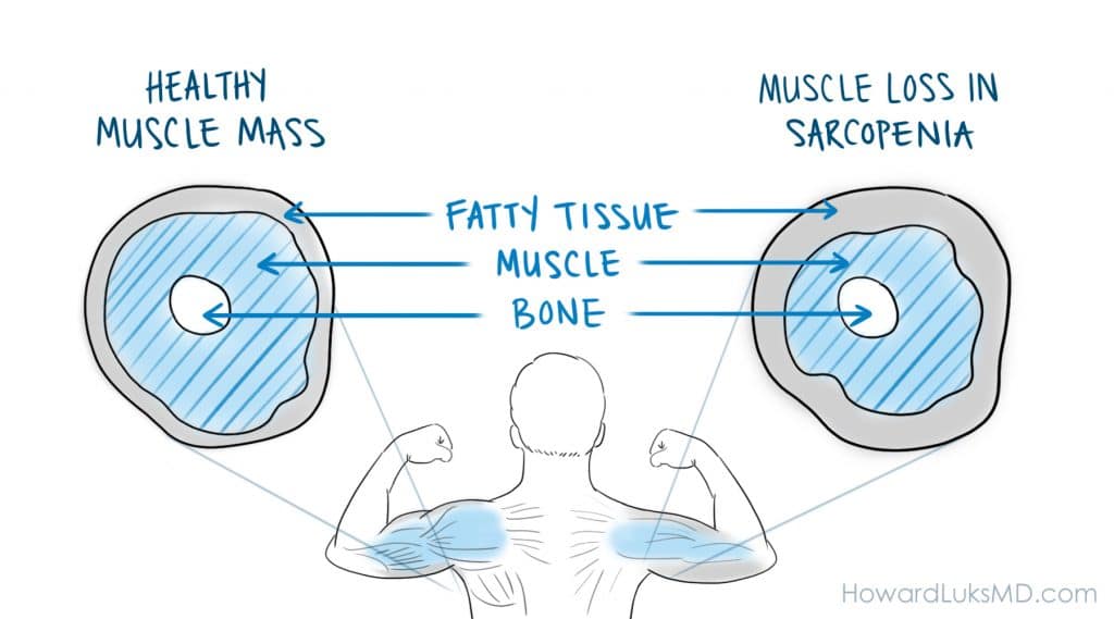 sarcopenia and loss of muscle Howard Luks MD