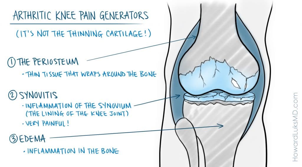 Causes of knee pain associated with osteoarthritis