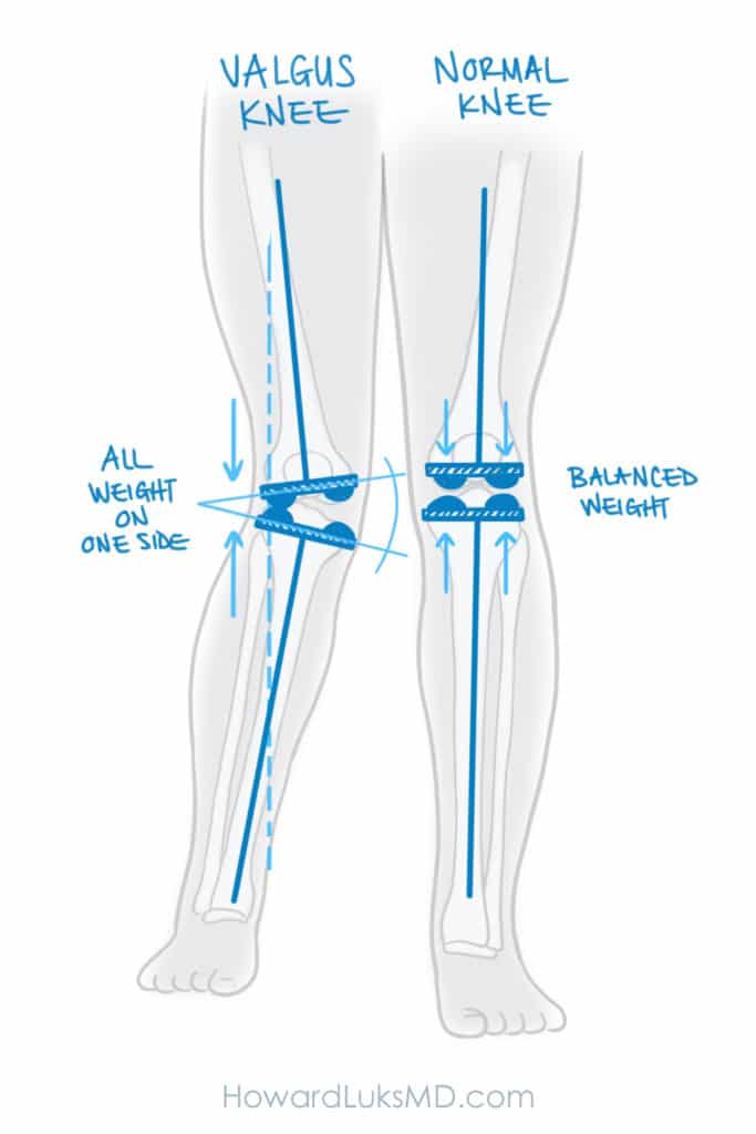 knock kneed deformity and knee arthritis