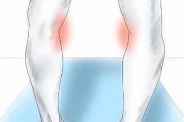 Bowed legs and medial knee pain