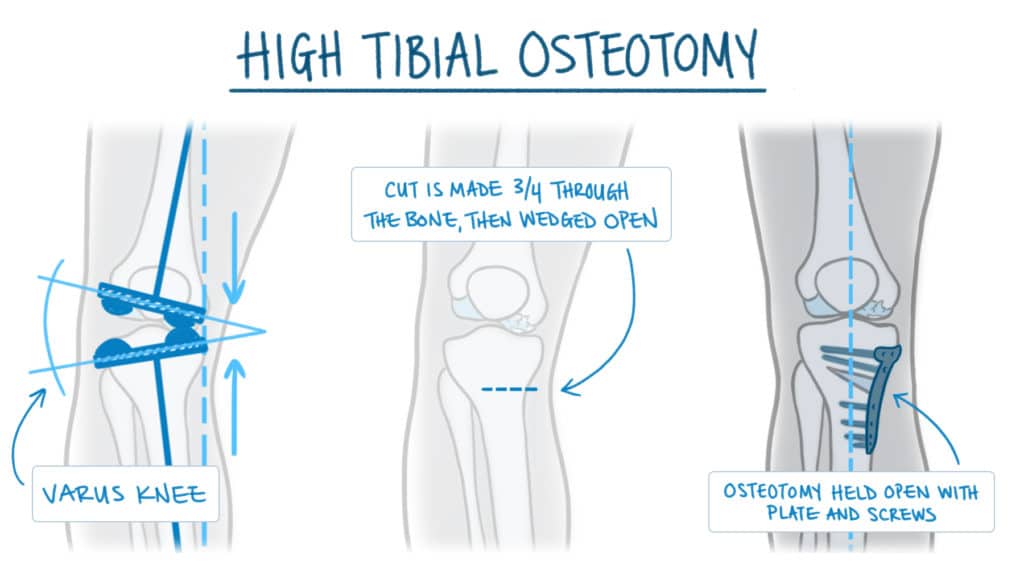 How an HTO improves knee pain due to arthritis