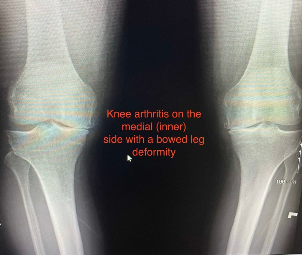 Knee Xray with bowed leg and medial joint space narrowing