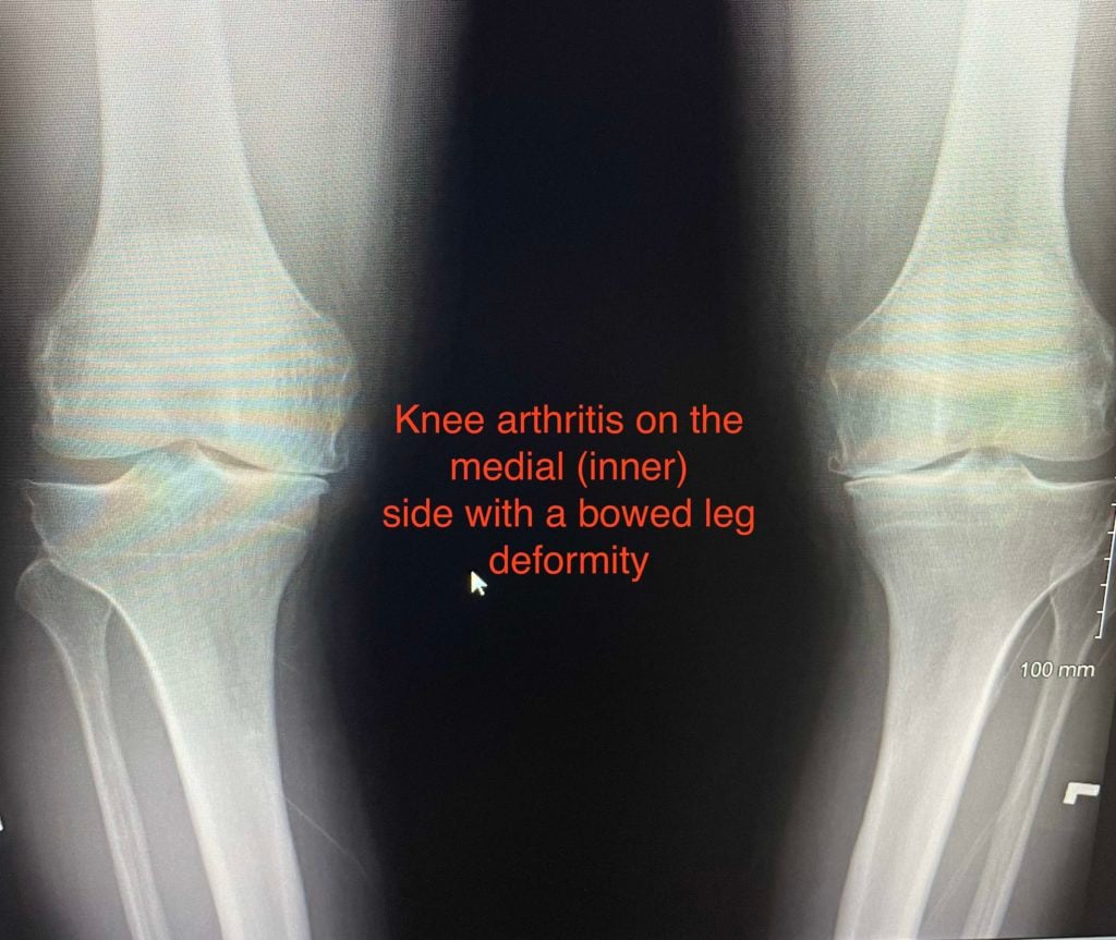 What Is Medial Joint Space Narrowing Howard J Luks Md