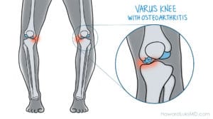 bowed knee and knee arthritis before osteotomy