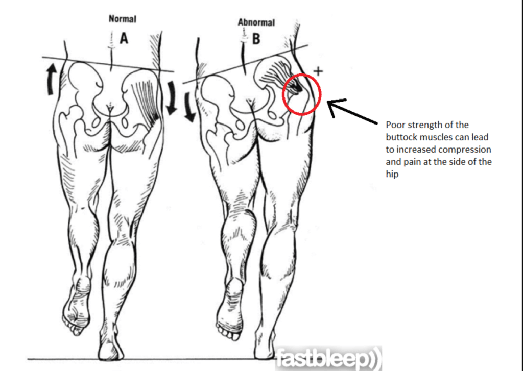 https://www.howardluksmd.com/wp-content/uploads/2022/01/Hip-pain-on-the-outside-due-to-pelvic-tilt-1024x727.png