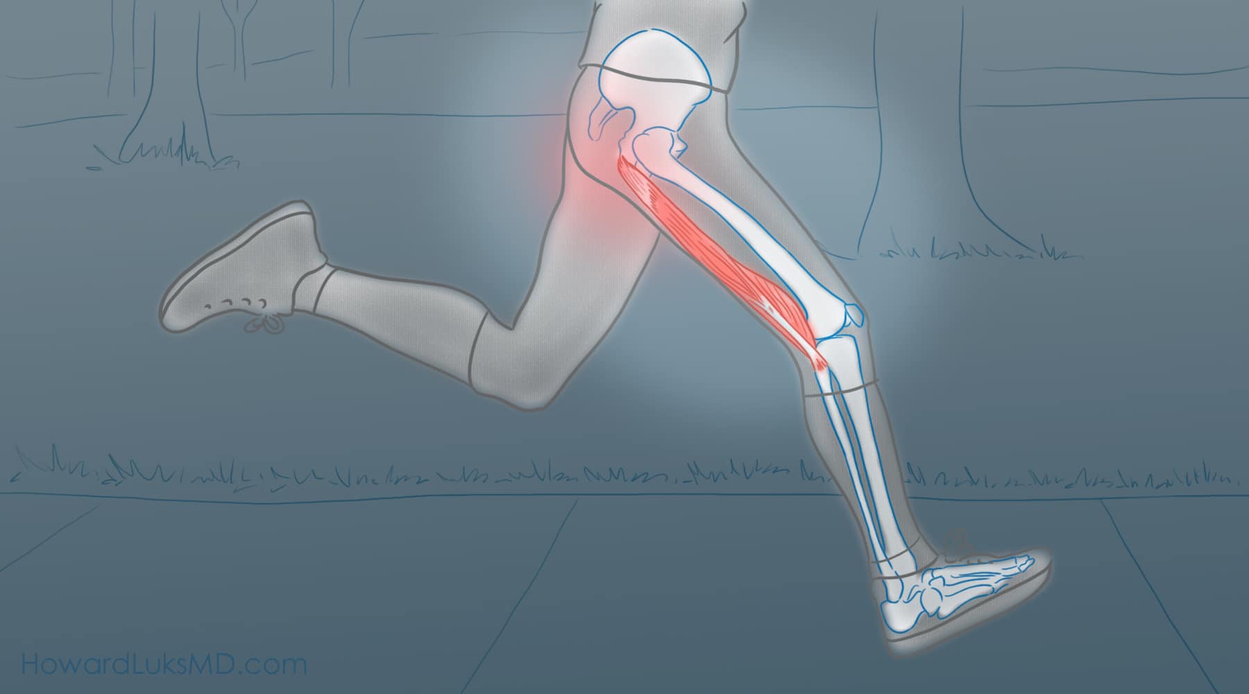 Proximal hamstring tendinopathy- a true pain in the butt