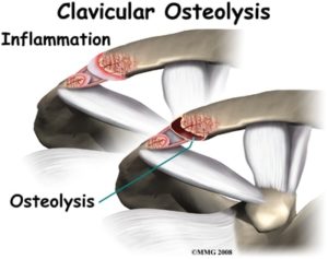 distal clavicle osteolysis