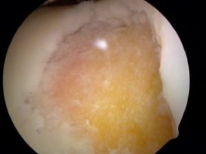 Cartilage defect prepared