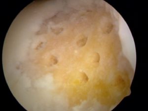 Microfracture for cartilage defect