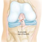 anterior cruciate ligament injury prevention