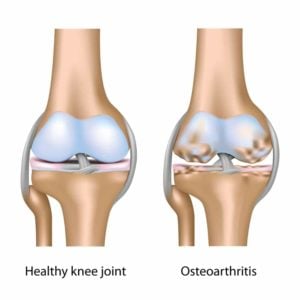 PRP Arthritis of the Knee