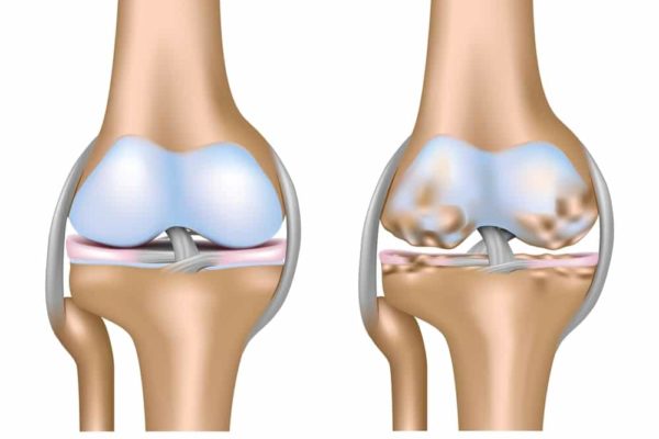 PRP Arthritis of the Knee